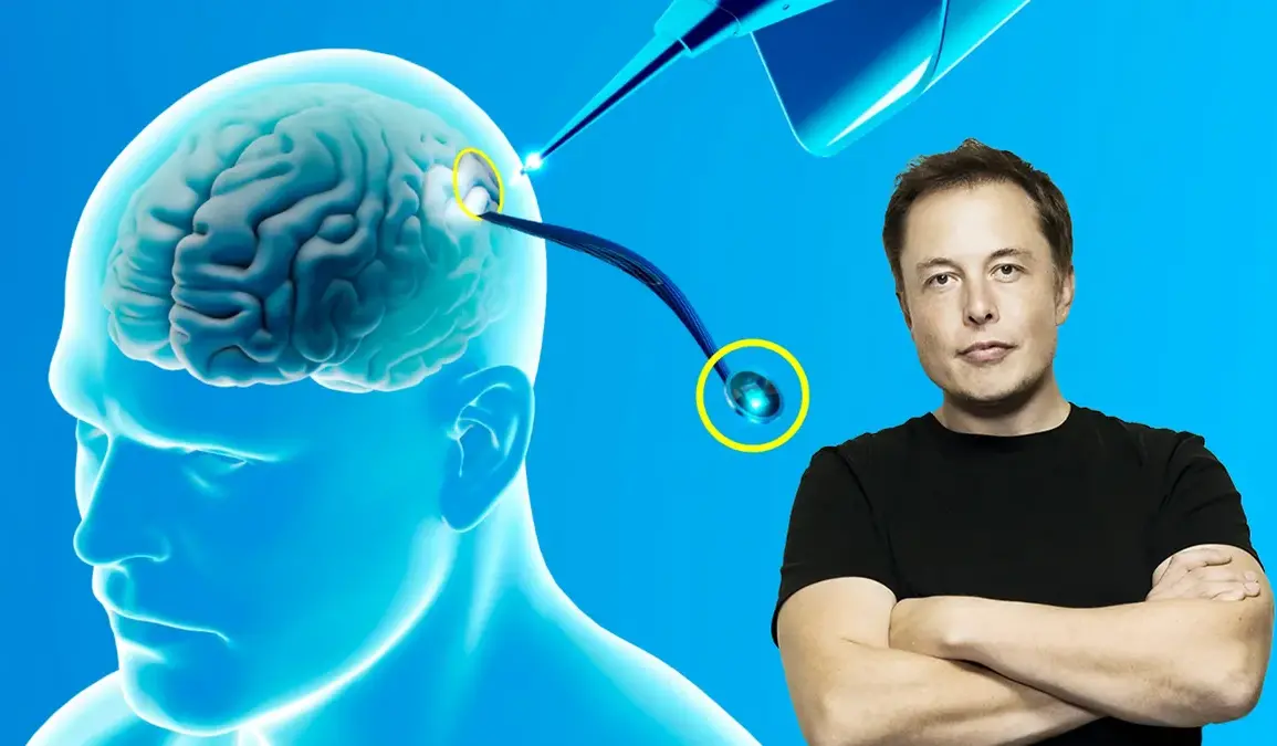 Чи Ілон Маск першим, хто імплантував чіп у мозок